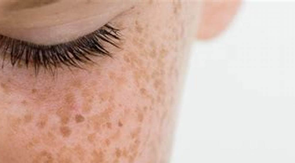 Pigmentation Treatment Birmingham Clinic KHD Aesthetics